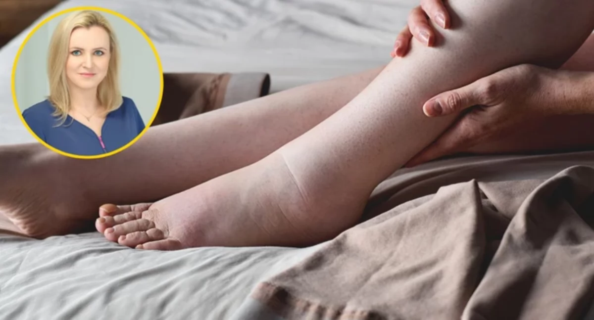 Zdrowie, czego bierze zakrzepica Kardiolog omija młodych potencjalnie zdrowych - zdjęcie, fotografia