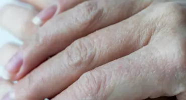 Niedoczynność tarczycy – złodziej energii. Pierwsze objawy, kiedy do lekarza? 